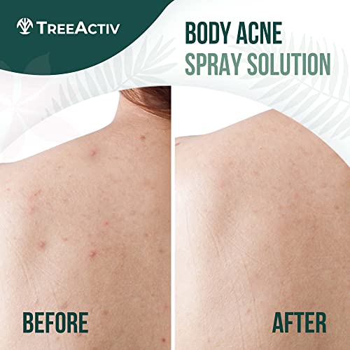 TreeActiv Salicylic Acid Back & Body Acne Spray, Back Acne Solution For Women And Men, Acne Body Spray with Tea Tree Oil, Fast-Drying Back Acne Spray, Fine Mist, Back Acne Treatment Spray, 4oz, 2-pack