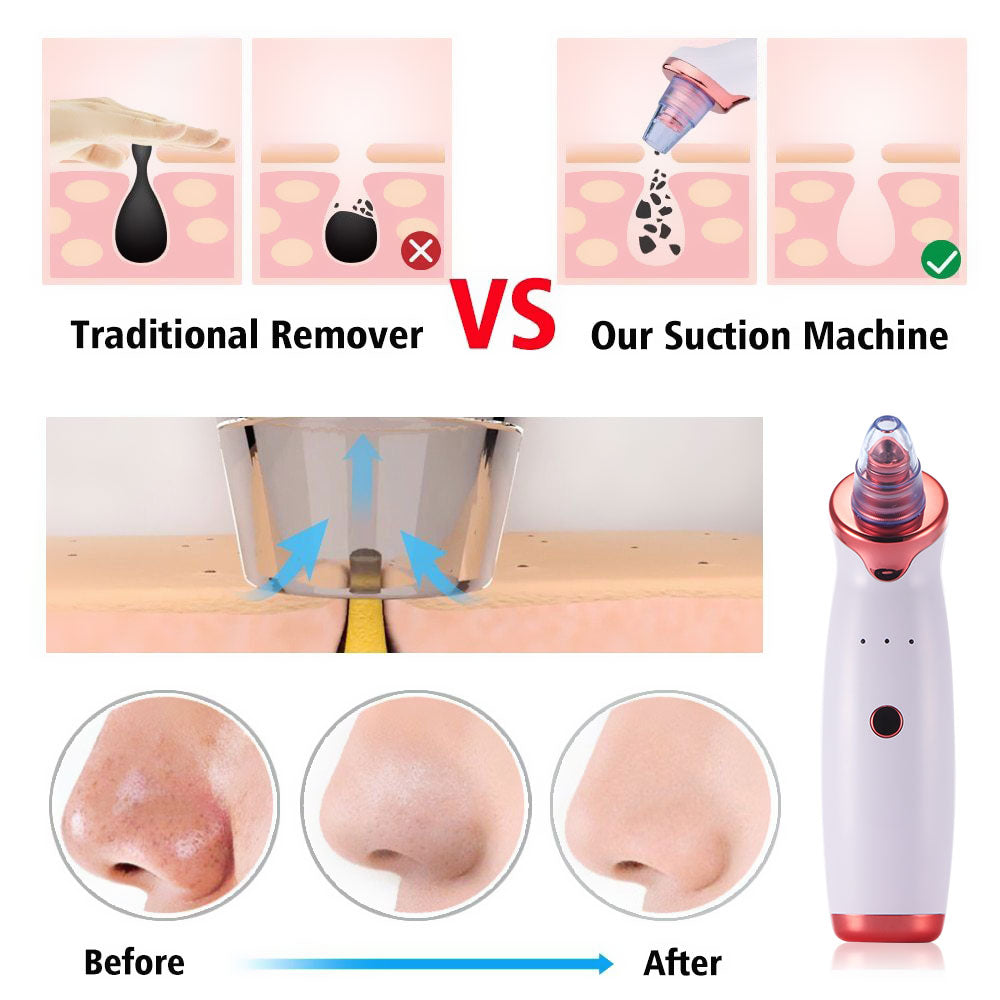 Electric Acne Remover